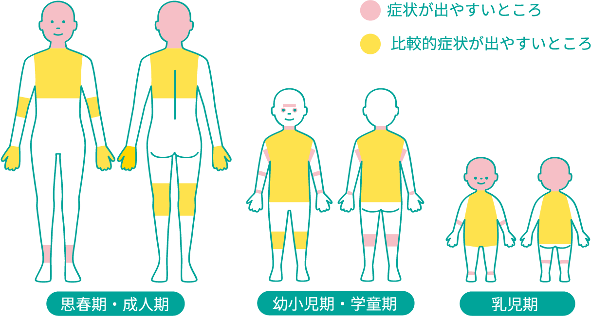 アトピー性皮膚炎の湿疹が出やすいところ